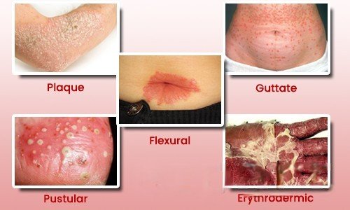 Psorolin-B Ointment 75gm12