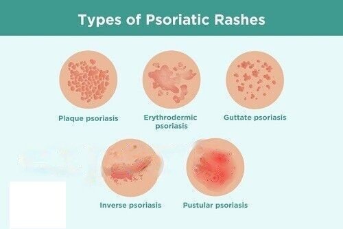 Psorolin-B Ointment 75gm3