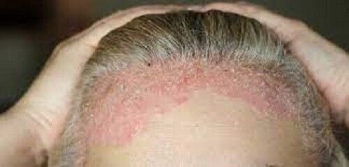 Psorolin-B Ointment 75gm34